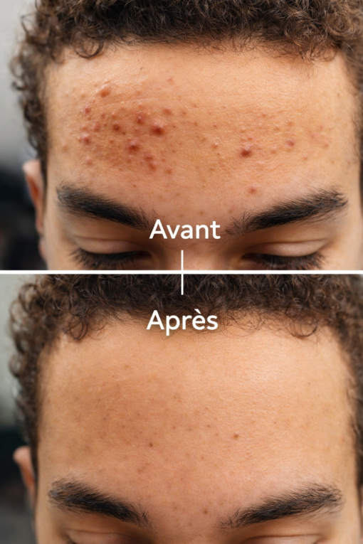 Sérum anti-acné, anti imperfection -30ml-